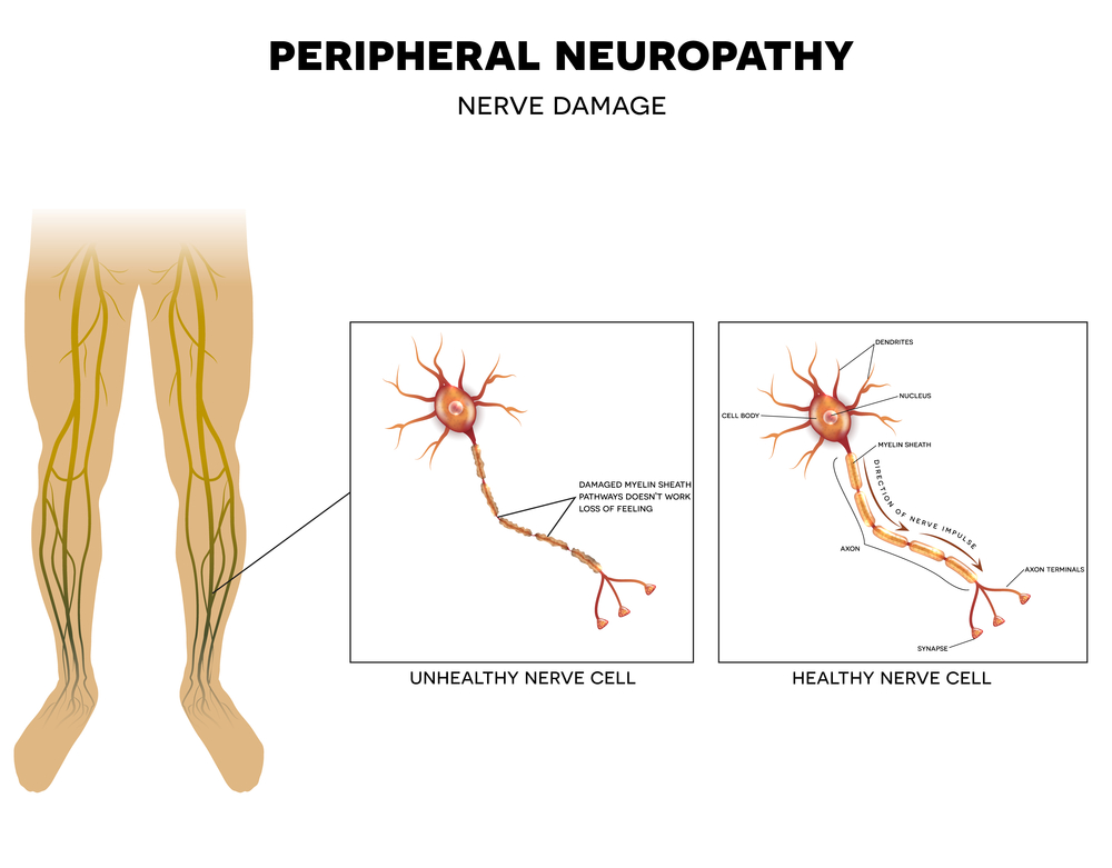 Sensory Neuropathy Vs Peripheral Neuropathy