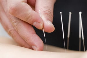 acupuncture needles