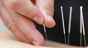 Top 5 Questions About Acupuncture