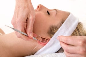 woman receiving acupuncture and auriculotherapy at a doctor's office