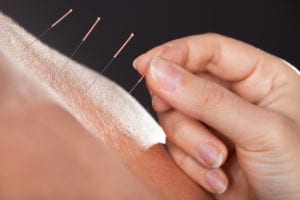 acupuncture in the upper back