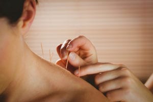 Your CHiropractor in Roanoke, TX offer Acupuncture Care for Pain Relief